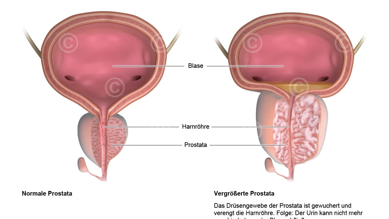 Flutamide et Cancer de la Prostate: Un Guide pour Faire Face aux Effets Secondaires